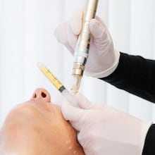 During a PRP facial, platelet-rich plasma — often called “liquid gold” for its regenerative properties — is applied to freshly microneedled skin to encourage healing and radiance.