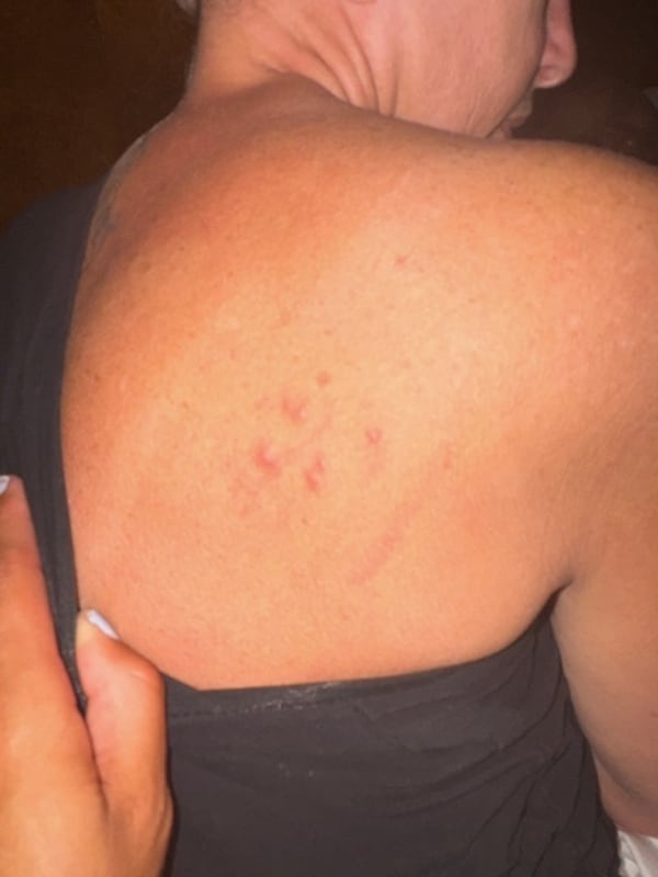 Milton resident Mellissa Hairston was stung by the Asian needle ant six times. (Courtesy of Mellissa Hairston)