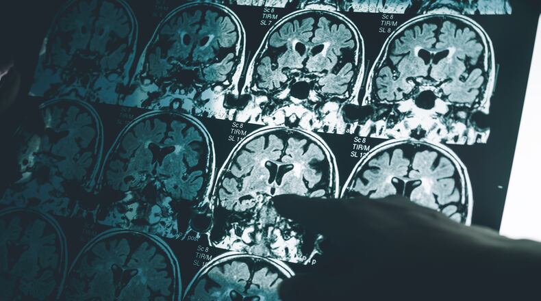 A new study is offering hope for a simple and accurate blood test that can diagnose Alzheimer’s disease in its early stage. (Atthapon Raksthaput/Dreamstime/TNS)