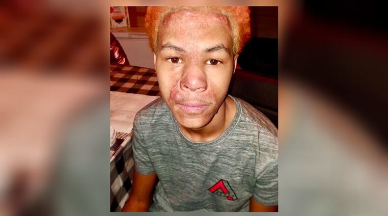 Malachi McFadden was left with burns on his face, neck and arms after a chemistry demonstration at Redan High School went awry, attorney L. Chris Stewart said.