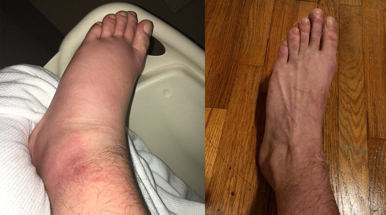 Paul Sweatman’s foot swelled up with a mystery bacterial infection in the fall of 2017, and an urgent care clinic told him to get to the emergency room. The hospital treated him for three days and the foot did not have to be amputated. But days later the swelling returned, and he rushed back to the ER. Anthem/Blue Cross said the second visit was not an emergency and refused to pay. These photos show the foot during Sweatman’s first trip to the hospital, and as it usually is, this week. (Photos courtesy of Paul Sweatman)