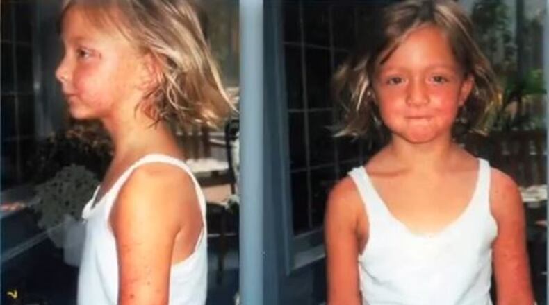 Madison Harty, five years old in this photo, had to undergo six surgeries to repair damage to her arm when the family was in a wreck 15 years ago. First responders said the fact that she was in a booster seat saved her life. CONTRIBUTED