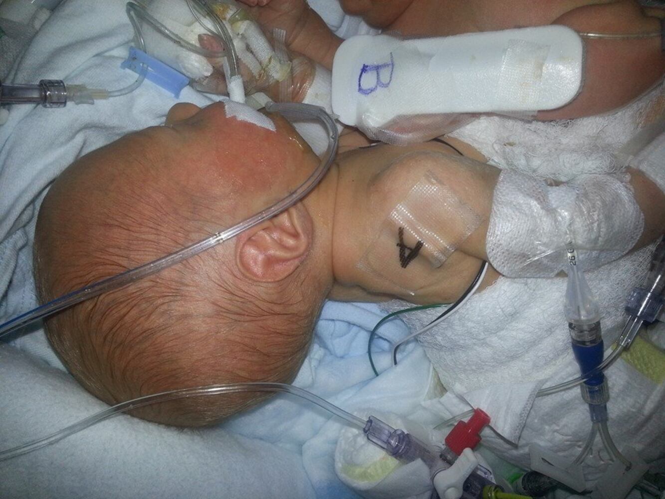 Conjoined twins born in Jacksonville