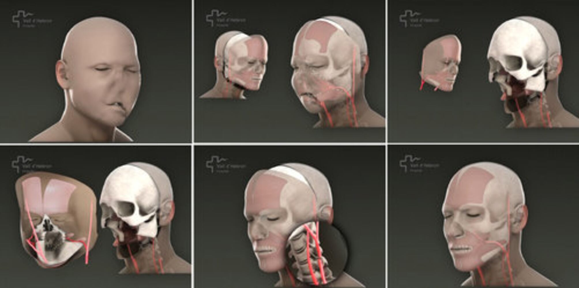 Spain's face transplant success stories