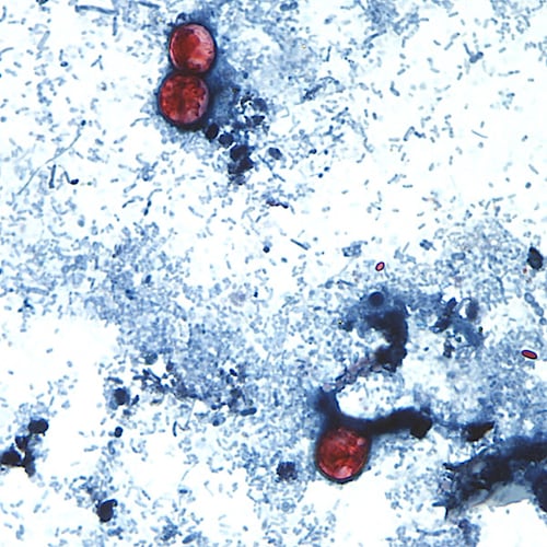 This undated photo taken through a microscope provided by the CDC shows Cyclospora cayetanensis oocysts found in a fresh stool sample which had been prepared with a formalin solution and stained with safranin. (CDC via AP)