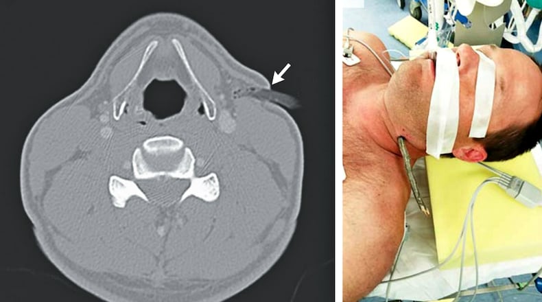 Tree branch in riders neck