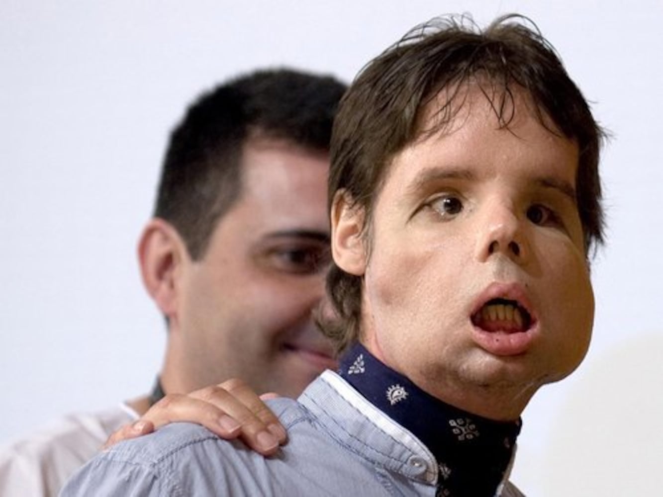 Spain's face transplant success stories