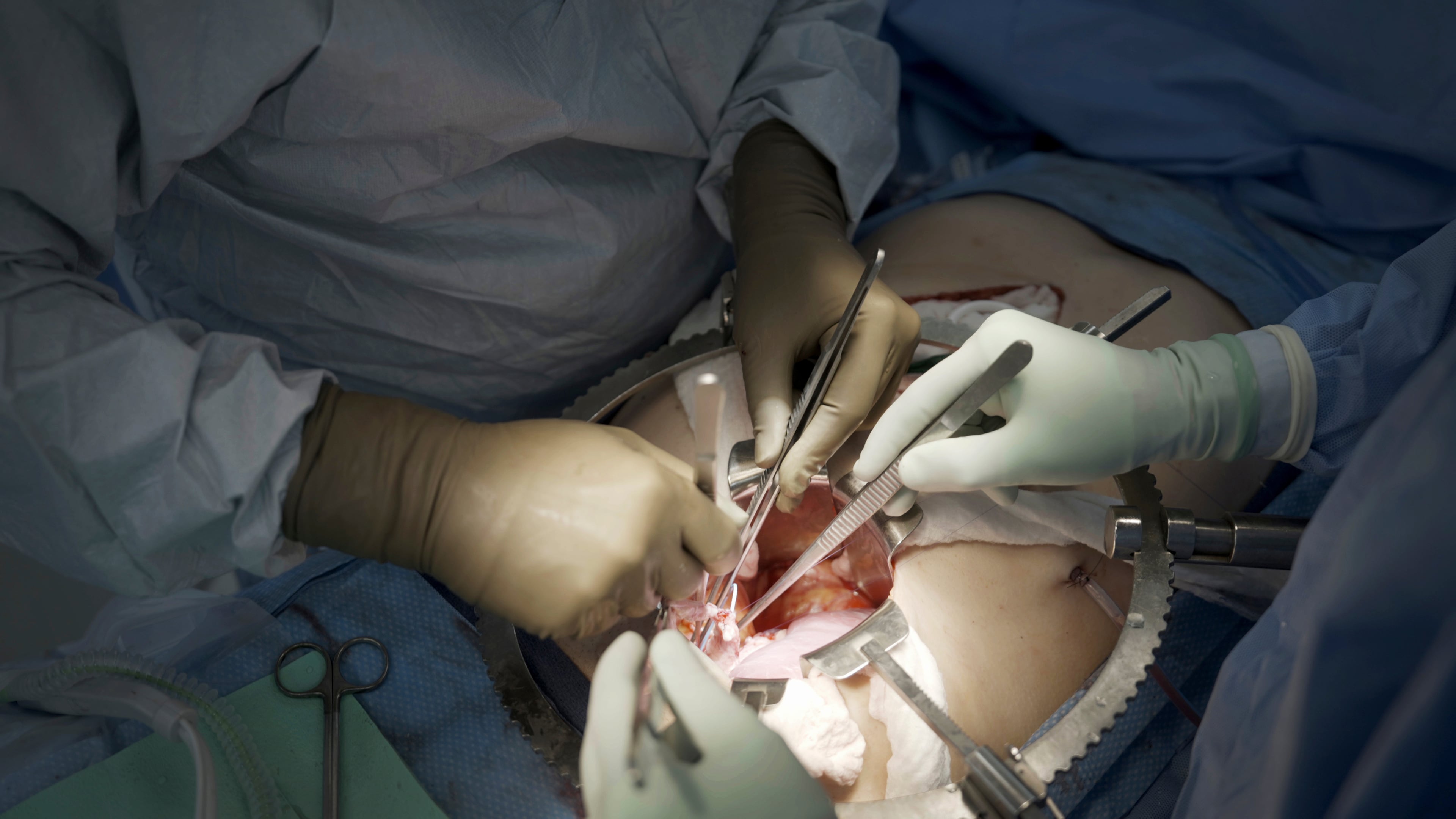 FILE - Surgeons at NYU Langone Health prepare to transplant a pig's kidney into a brain-dead man in New York on July 14, 2023. (AP Photo/Shelby Lum, File)
