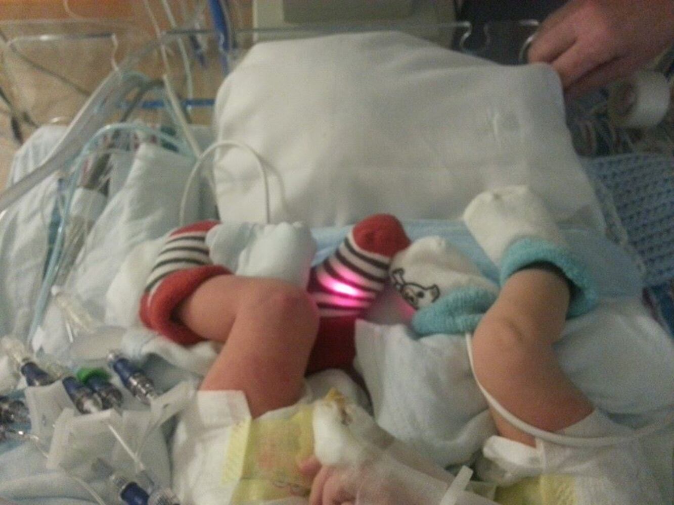 Conjoined twins born in Jacksonville