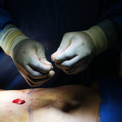 Plastic surgeon Dr. Michael Obeng performs a belly bottom reconstruction plastic surgery after a tummy tuck at a surgical center in Beverly Hills, Calif., on Thursday, Feb. 5, 2026. (AP Photo/Damian Dovarganes)