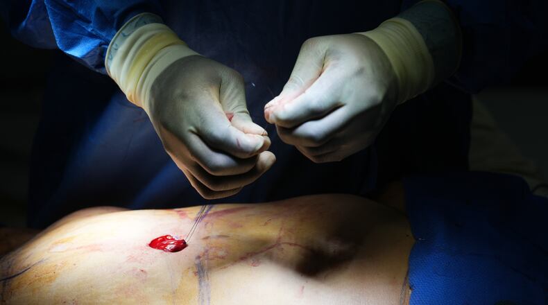 Plastic surgeon Dr. Michael Obeng performs a belly bottom reconstruction plastic surgery after a tummy tuck at a surgical center in Beverly Hills, Calif., on Thursday, Feb. 5, 2026. (AP Photo/Damian Dovarganes)