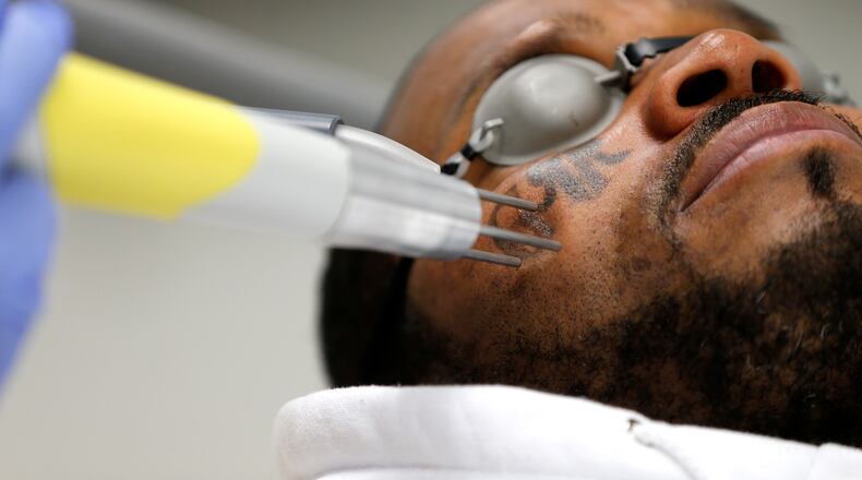 Charles Greene has his second of nine treatments to remove a tattoo from his cheek by Chuck Powell of East Coast Laser Tattoo Removal in Henrico, Va. (Mark Gormus/Richmond Times-Dispatch via AP)