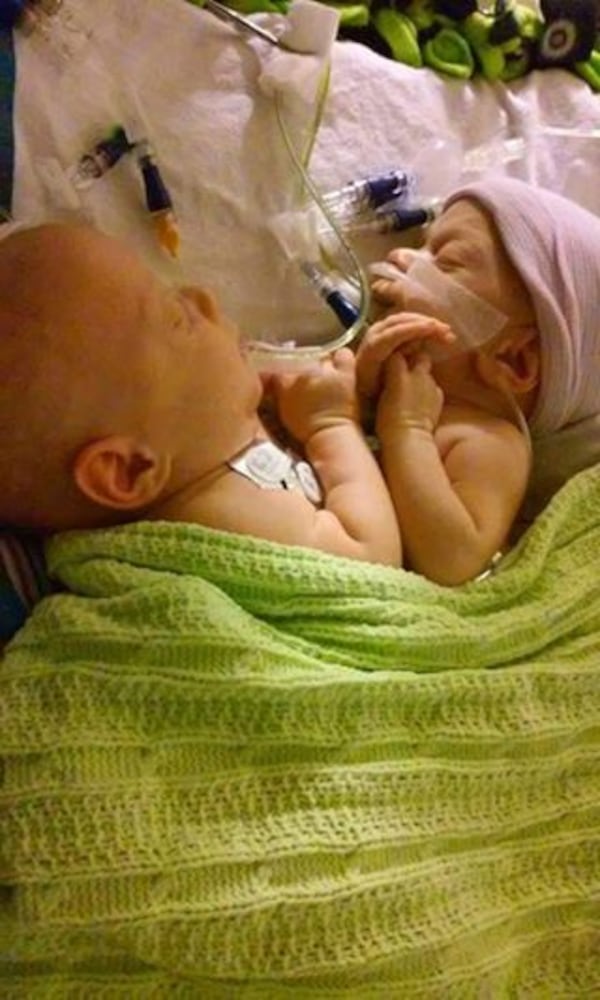 Condition of conjoined twins Carter and Conner improving