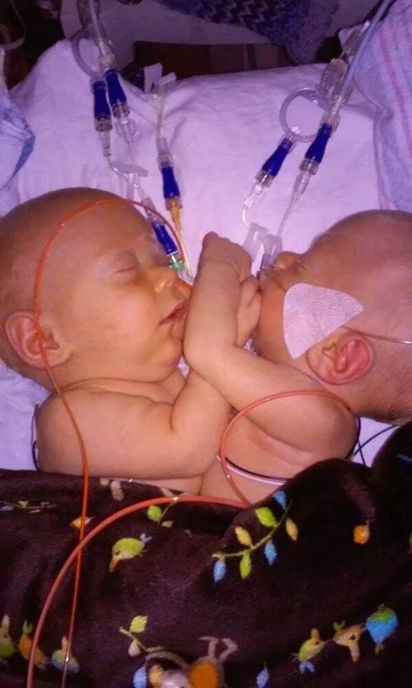 Conjoined twins Carter and Conner