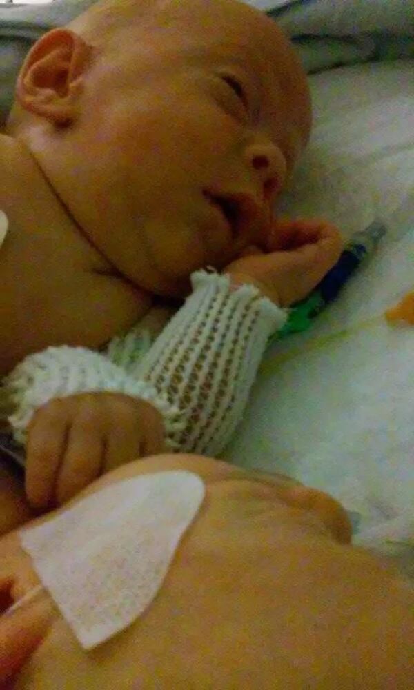 Conjoined twins Carter and Conner