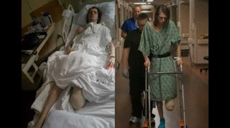 Austin Stroud’s left foot had to be amputated.