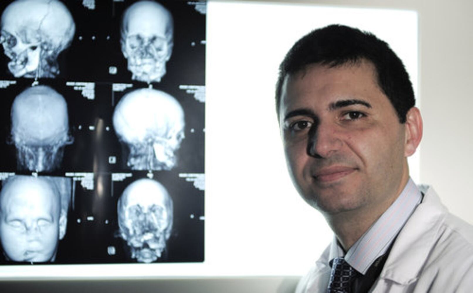 Spain's face transplant success stories