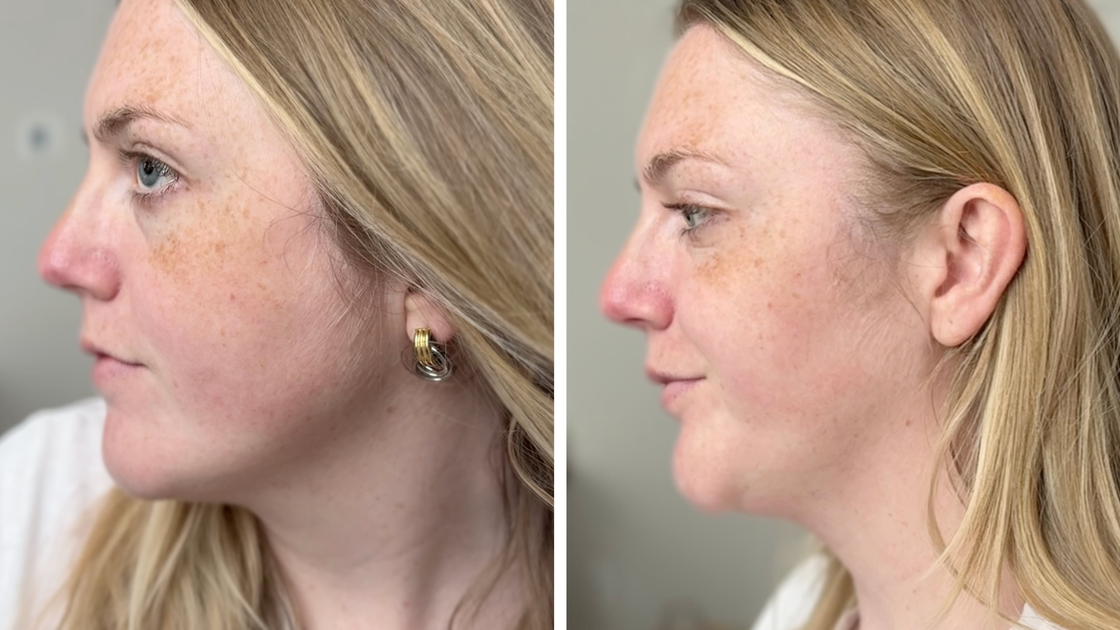 The results were subtle, but after a month of using the Omnilux Mini Skin Corrector, the redness on my cheek had faded a bit and the texture looked smoother. It didn’t “fix” my rosacea, but it definitely helped my skin feel more balanced. (Avery Newmark/AJC)