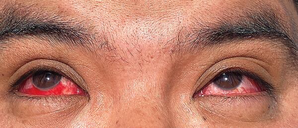 A photograph of the eyes of an infected dairy worker in Texas, with ruptured blood vessels and bleeding conjunctiva. (The New England Journal of Medicine ©2024)