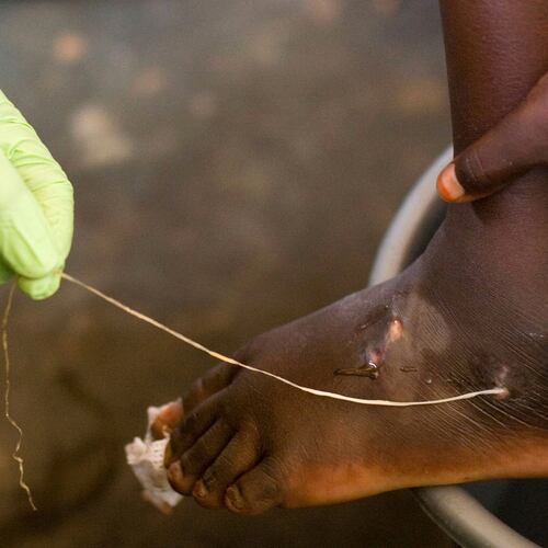 FILE - In this March 9, 2007 file photo, a guinea worm is extracted by a health worker from a child's foot at a containment center in Savelugu, Ghana. (AP Photo/Olivier Asselin, File)