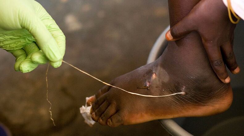 FILE - In this March 9, 2007 file photo, a guinea worm is extracted by a health worker from a child's foot at a containment center in Savelugu, Ghana. (AP Photo/Olivier Asselin, File)