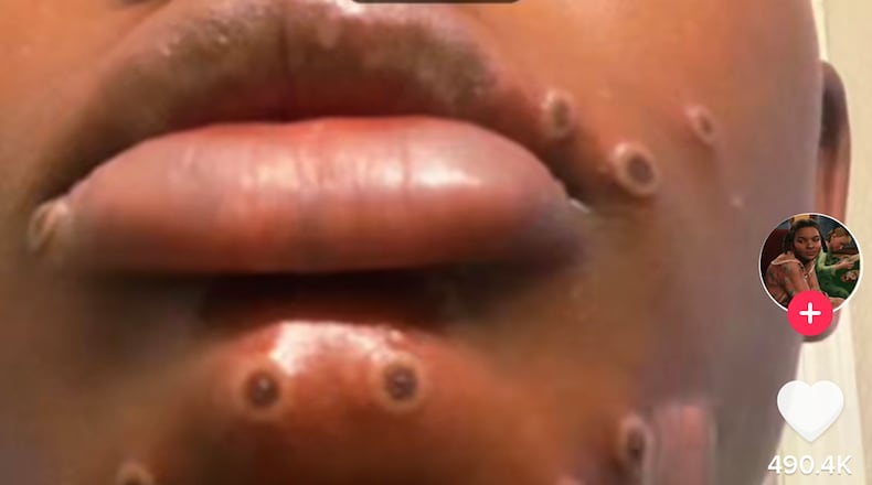 Camille Seaton, a 20-year-old from Marietta, turned to social media to share her experience with monkeypox. The Georgia Department of Public Health confirmed its first case of monkeypox in a female in late July 2022. (TikTok screenshots)