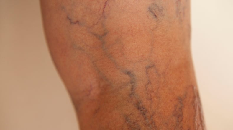 Tall people more likely to develop varicose veins, study says
