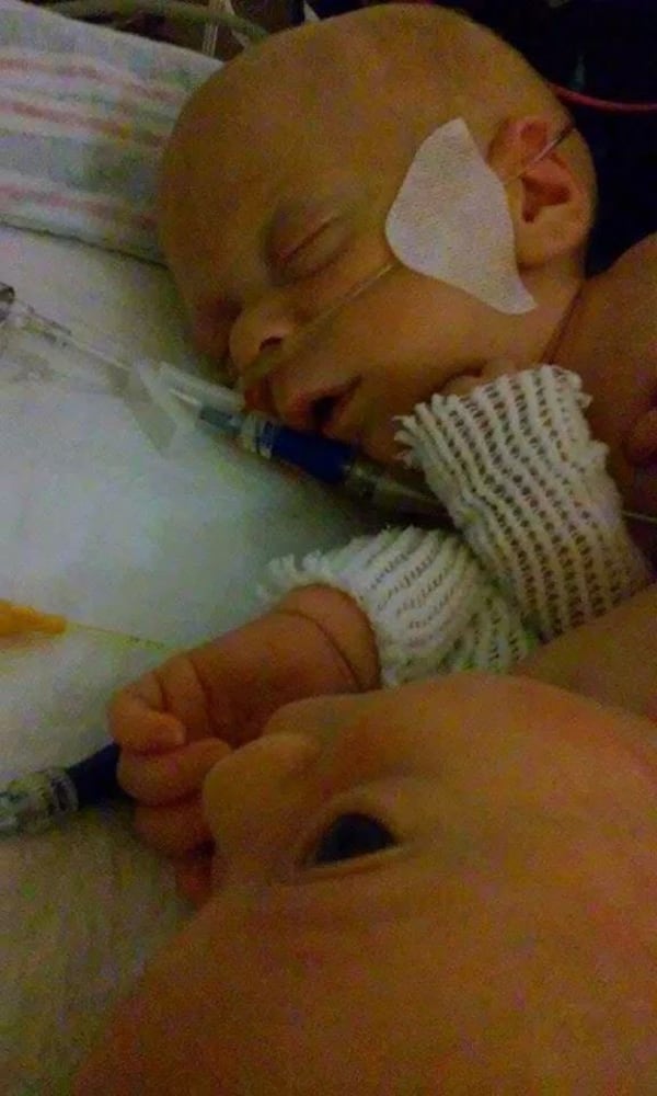 Conjoined twins Carter and Conner