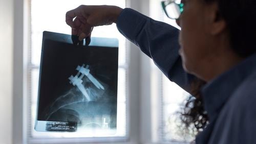 Cindy Wilburn, a former DeKalb County School District teacher, holds up x-ray photos of her first surgery to her spine after being pushed down bleachers by a student in 2001.