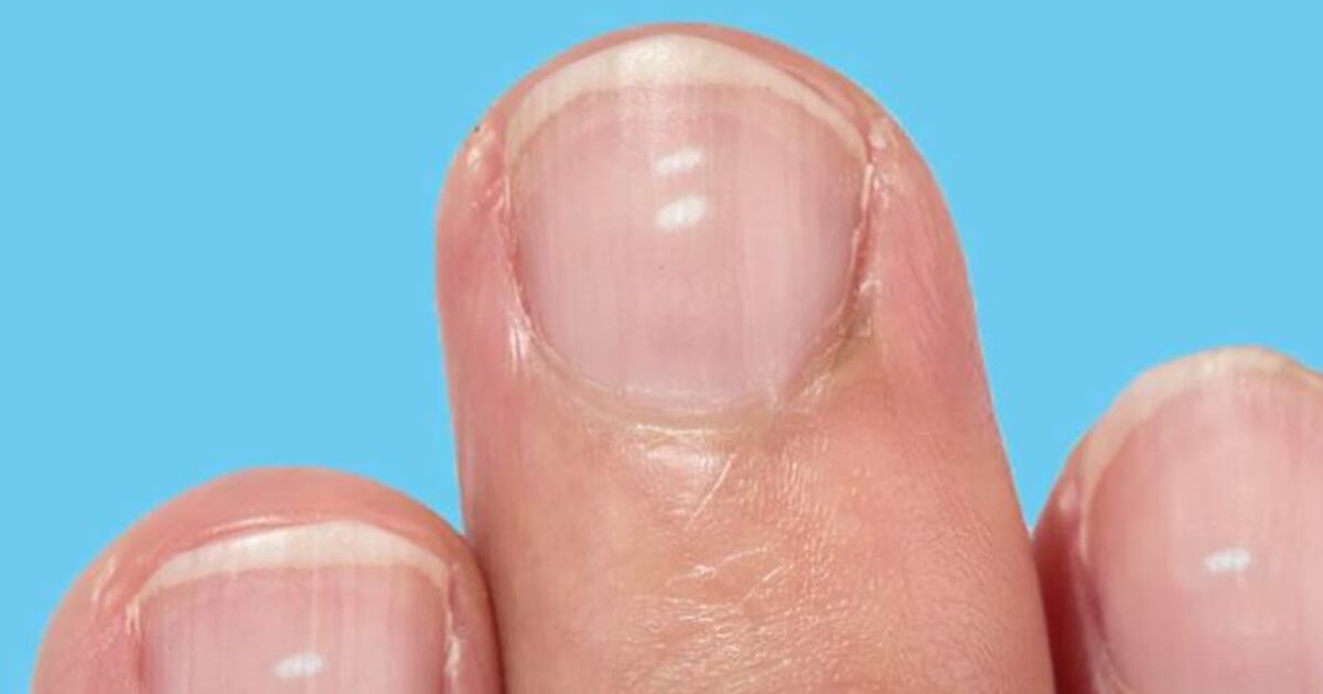 Leukonychia: What are those white marks on your nails?