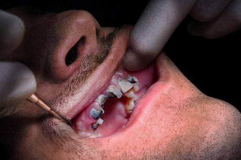 A Georgia meth user being examined by a dentist in 2007.(Kimberly Smith / AJC staff)