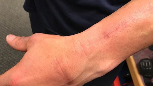 Tyler Flowers has a surgical scar across his left hand just below the wrist, and another running vertically up the left forearm. Both were spot where he was hit by pitches last season, the damage repaired in one October surgery. (Photo by David O’Brien)